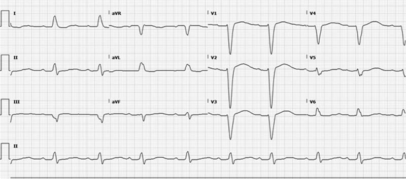 Loperamide-Induced Ventricular Tachycardia Storm.