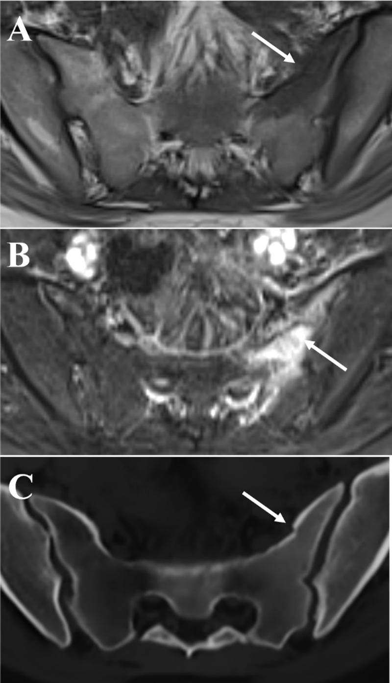 MRI AI Use Case: Synthetic CT Images for Fracture Evaluation.