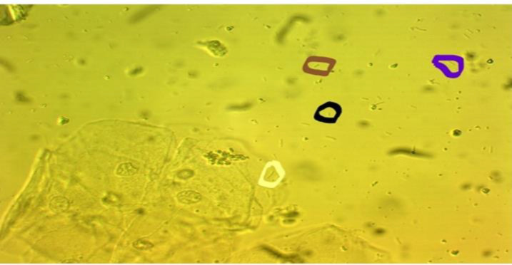 Challenging Vaginal Discharge, Lactobacillosis and Cytolytic Vaginitis.