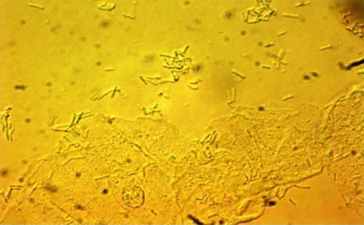 Challenging Vaginal Discharge, Lactobacillosis and Cytolytic Vaginitis.