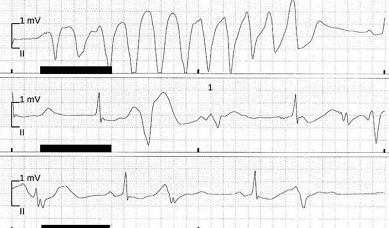 Loperamide-Induced Ventricular Tachycardia Storm.