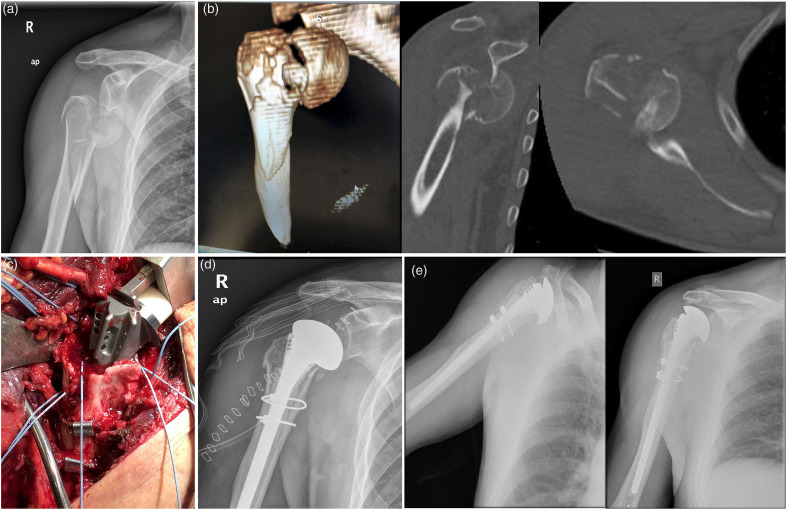 Long-stemmed Hemiarthroplasty with Cerclage Wiring for the Treatment of Split-Head Fractures of the Proximal Humerus with Metaphyseal Extension: A Report of 2 Cases.