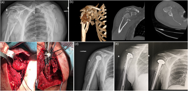 Long-stemmed Hemiarthroplasty with Cerclage Wiring for the Treatment of Split-Head Fractures of the Proximal Humerus with Metaphyseal Extension: A Report of 2 Cases.