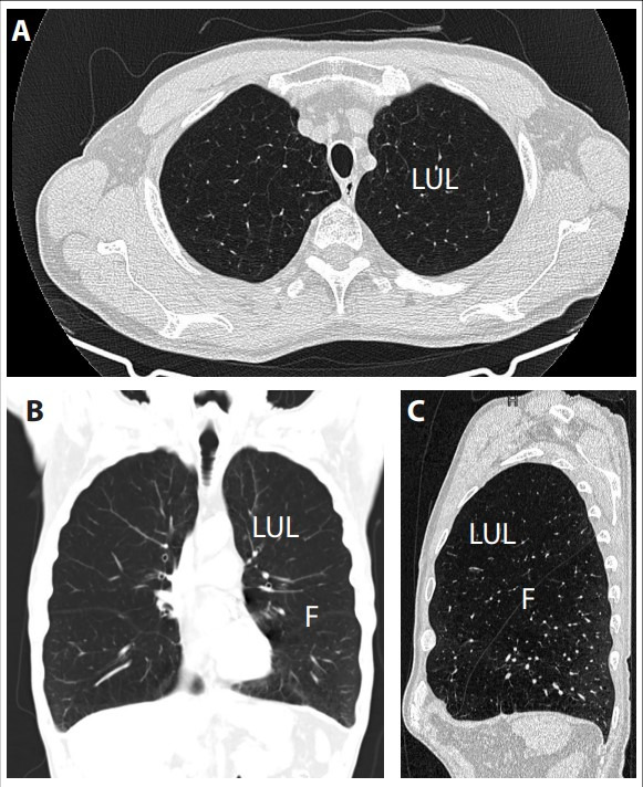 Position statement on endoscopic lung volume reduction in South Africa: 2022 update.