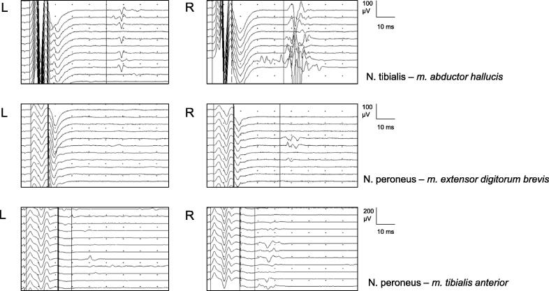 Are nerve conduction studies altered in functional neurological disorders?