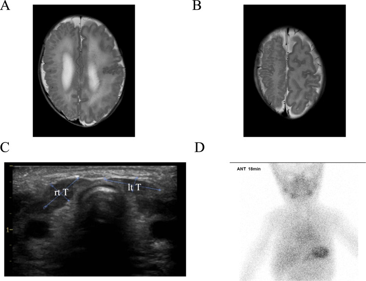 Thyroid hypogenesis is associated with a novel AKT3 germline variant that causes megalencephaly and cortical malformation.