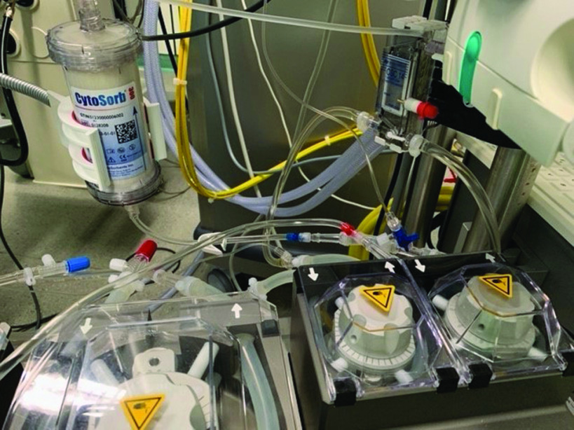 Hemoadsorption of Rivaroxaban and Ticagrelor during Acute Type A Aortic Dissection Operations.