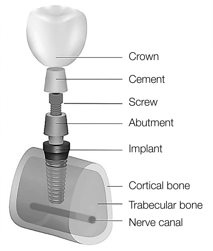 Biomechanical evaluations of the long-term stability of dental implant using finite element modeling method: a systematic review.