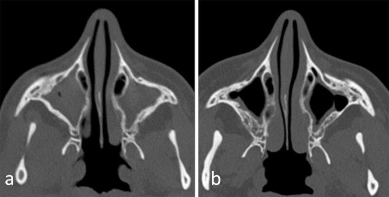 Sinus Disease Grading on Computed Tomography Before and After Modulating Therapy in Adult Patients with Cystic Fibrosis.