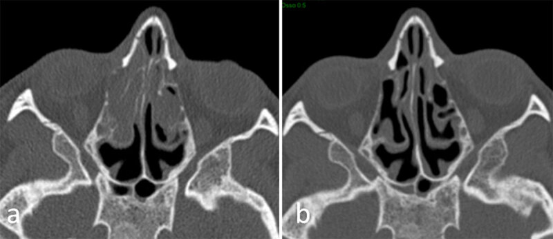 Sinus Disease Grading on Computed Tomography Before and After Modulating Therapy in Adult Patients with Cystic Fibrosis.