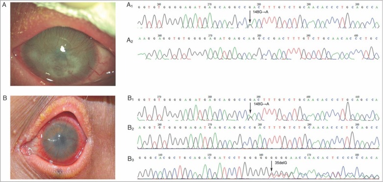 Keratitis-ichthyosis-deafness Syndrome with Heterozygous p.D50N in the <i>GJB2</i> Gene in Two Serbian Adult Patients.