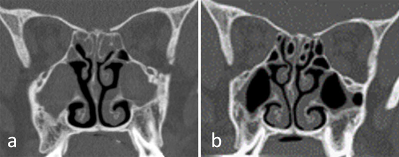 Sinus Disease Grading on Computed Tomography Before and After Modulating Therapy in Adult Patients with Cystic Fibrosis.