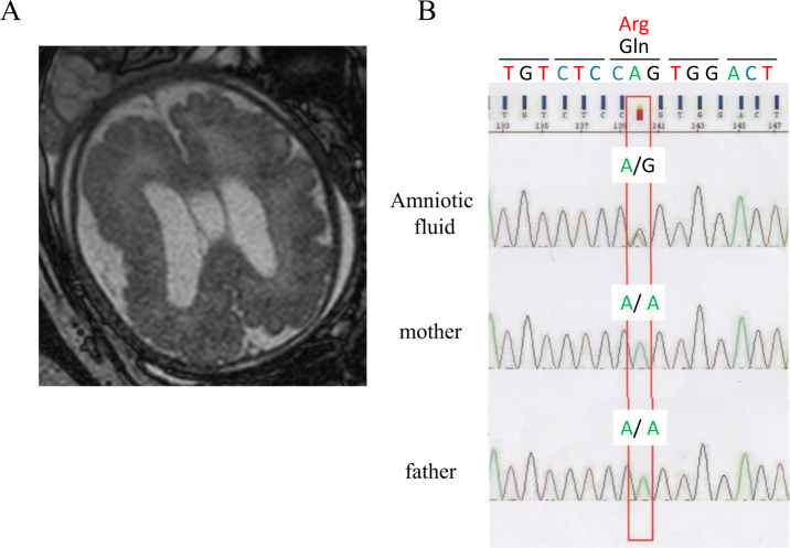 Thyroid hypogenesis is associated with a novel AKT3 germline variant that causes megalencephaly and cortical malformation.