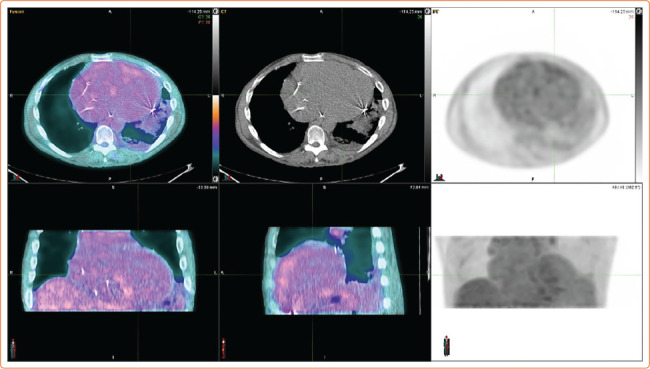 Co-occurrence of Myocardial Sarcoidosis and Left Ventricular Non-compaction in a Patient with Advanced Heart Failure.