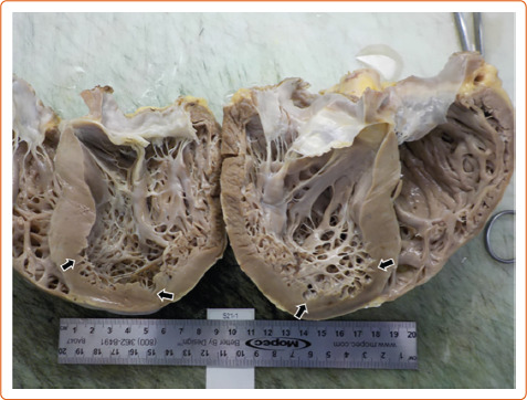 Co-occurrence of Myocardial Sarcoidosis and Left Ventricular Non-compaction in a Patient with Advanced Heart Failure.