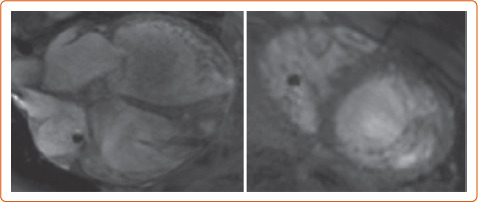 Co-occurrence of Myocardial Sarcoidosis and Left Ventricular Non-compaction in a Patient with Advanced Heart Failure.