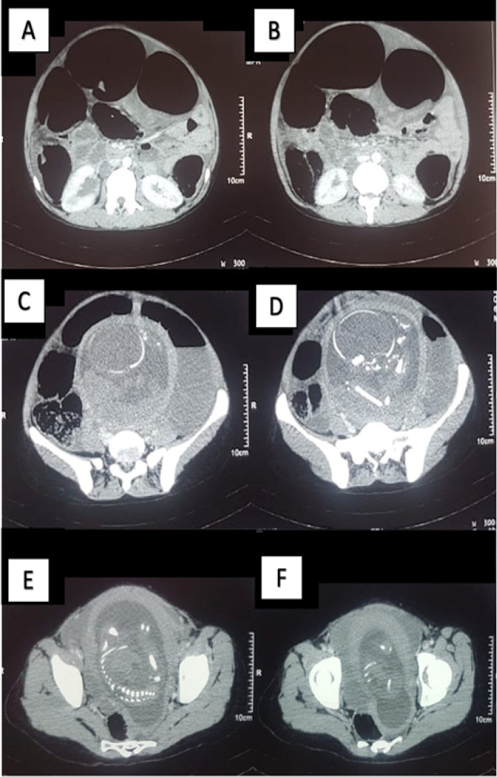 Management of sigmoid volvulus during labor : a challenging situation.