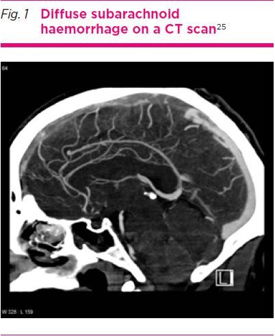 Imaging in headache disorders.