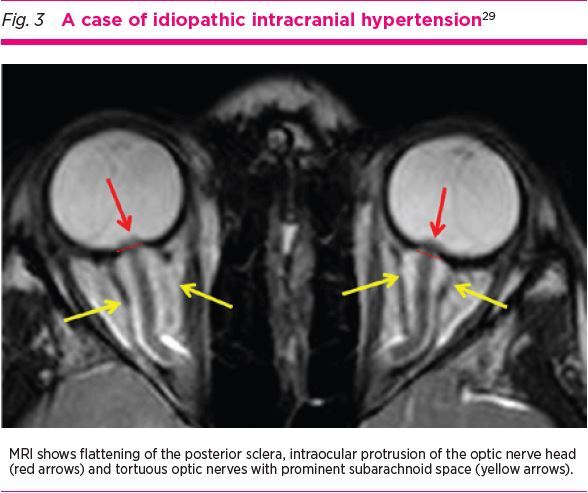 Imaging in headache disorders.