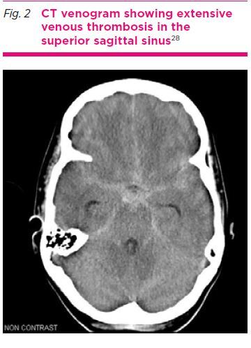 Imaging in headache disorders.