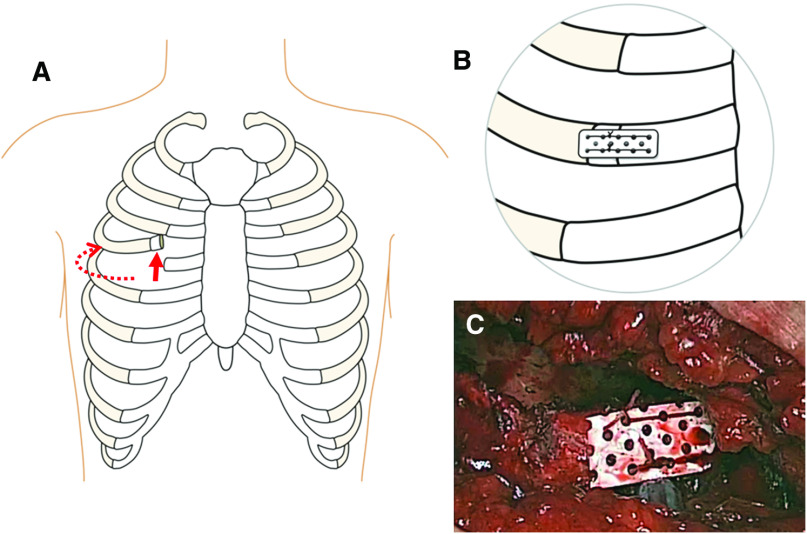 Comprehensive Pain Control Strategy in Minimally Invasive Mitral Valve Repair.