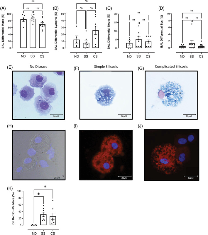 Excess iron promotes emergence of foamy macrophages that overexpress ferritin in the lungs of silicosis patients.
