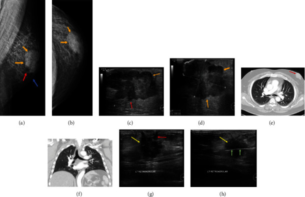 Profile of Male Breast Cancer in Makkah Region of Saudi Arabia: A 4-Year Retrospective Analysis of Radiology and Histopathology.