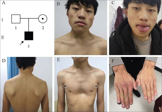 Novel <i>GPC3</i> Gene Mutation in Simpson-Golabi-Behmel Syndrome with Endocrine Anomalies: A Case Report.