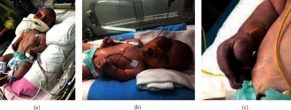 De Novo Heterozygous Mutation in FGFR2 Causing Type II Pfeiffer Syndrome.