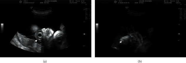 De Novo Heterozygous Mutation in FGFR2 Causing Type II Pfeiffer Syndrome.