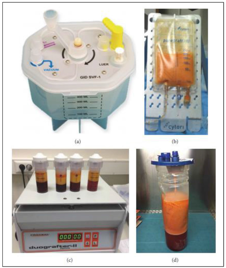 Stromal Vascular Fraction for Osteoarthritis of the Knee Regenerative Engineering.