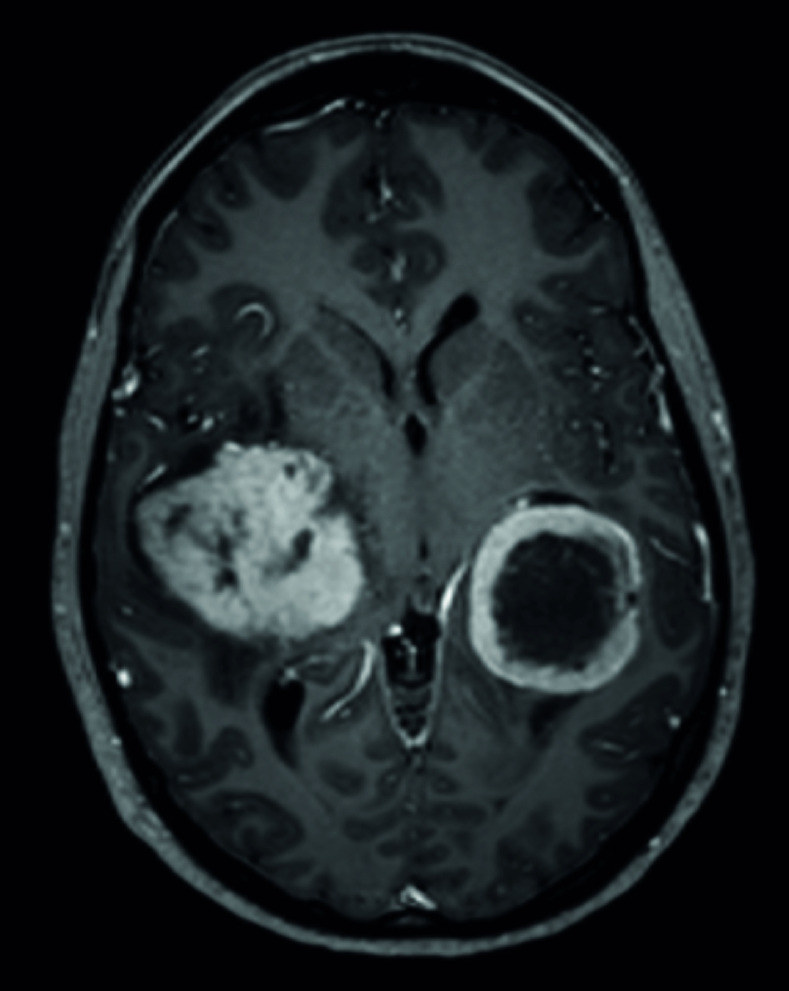 Large mirror brain metastases from primary undifferentiated sarcoma of the breast: case report and review of the literature.