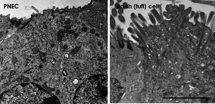 Pulmonary Neuroendocrine Cells and Small Cell Lung Carcinoma: Immunohistochemical Study Focusing on Mechanisms of Neuroendocrine Differentiation.