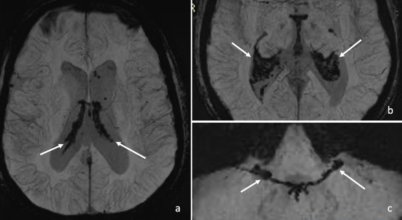 The Dark Pituitary: Hemochromatosis as a Lesser-Known Cause of Pituitary Dysfunction.