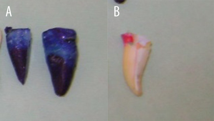 Evaluation of Apical Leakage After Root Canal Obturation with Glass Ionomer, Resin, and Zinc Oxide Eugenol Sealers Combined with Thermafil.