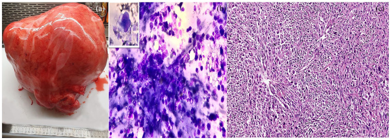 Morphological and Ancillary Features of Uterine Leiomyosarcoma: Case Report.