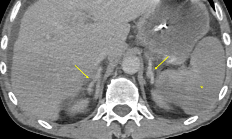 The Hollow Adrenal Gland Sign: An Ominous Alert.