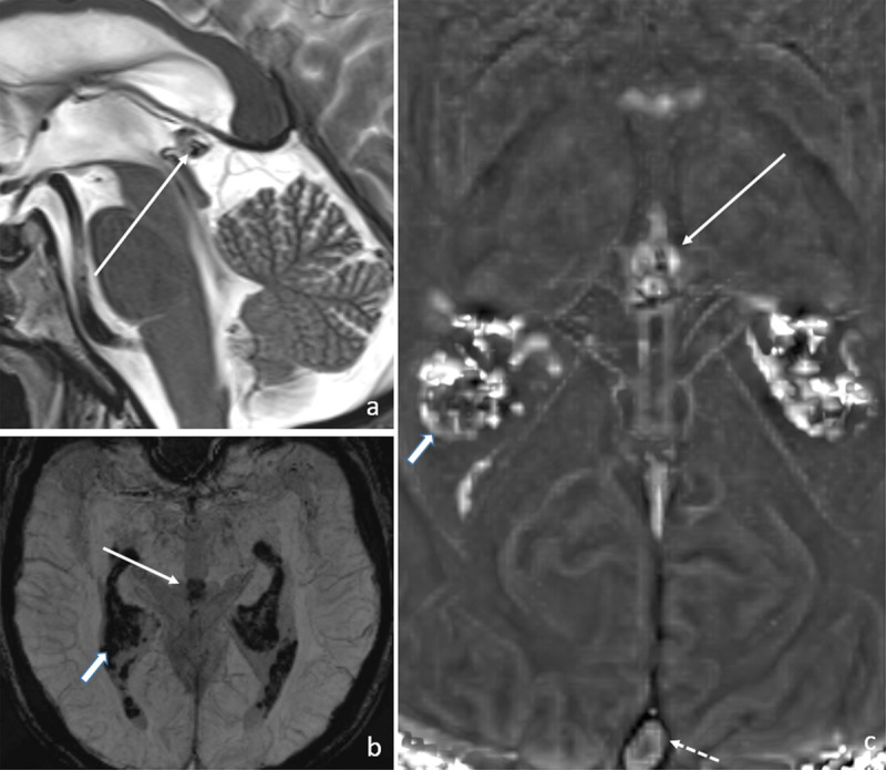 The Dark Pituitary: Hemochromatosis as a Lesser-Known Cause of Pituitary Dysfunction.