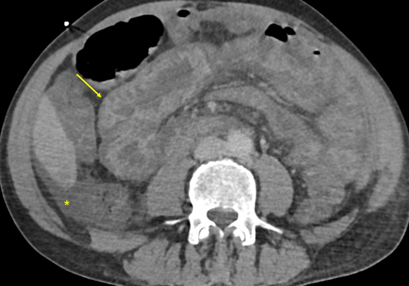 The Hollow Adrenal Gland Sign: An Ominous Alert.