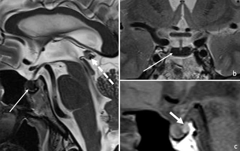 The Dark Pituitary: Hemochromatosis as a Lesser-Known Cause of Pituitary Dysfunction.