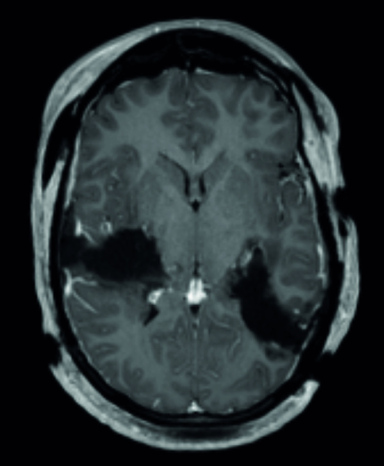 Large mirror brain metastases from primary undifferentiated sarcoma of the breast: case report and review of the literature.