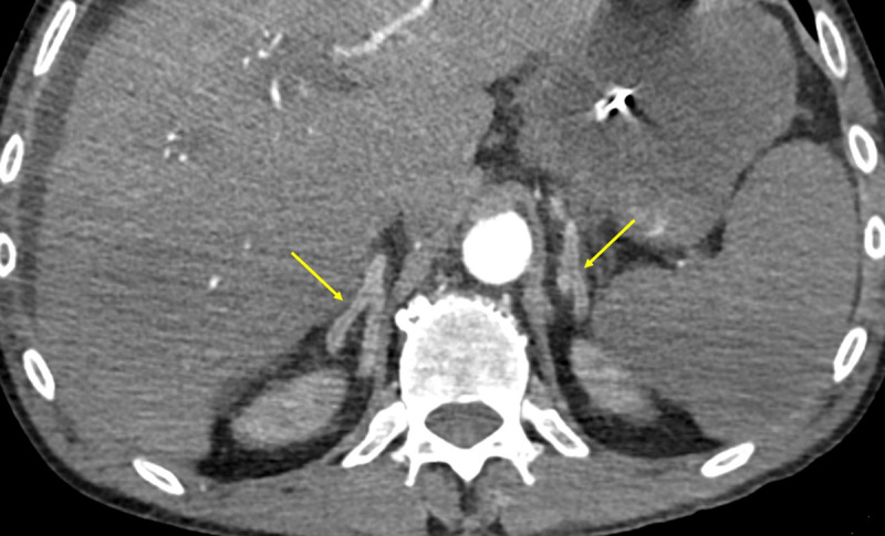 The Hollow Adrenal Gland Sign: An Ominous Alert.