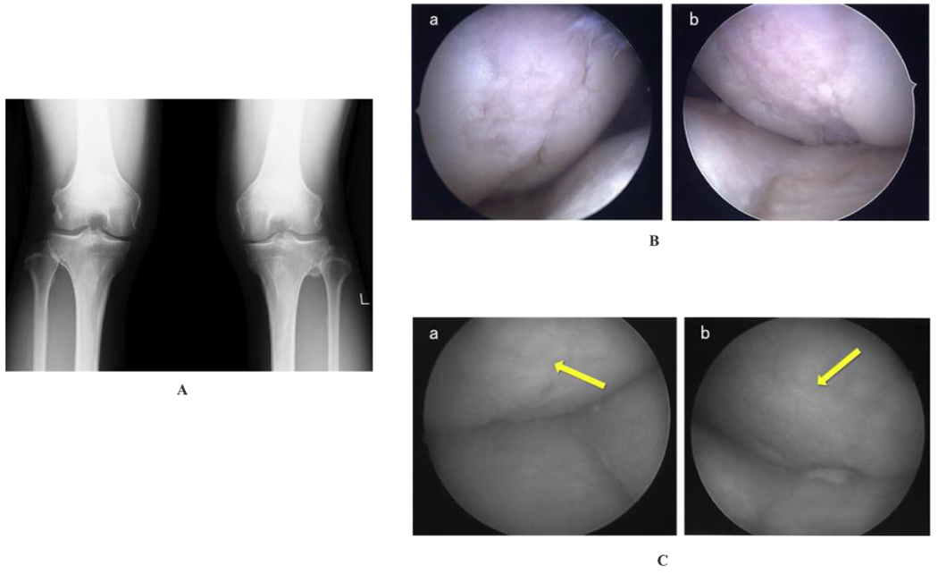 Stromal Vascular Fraction for Osteoarthritis of the Knee Regenerative Engineering.