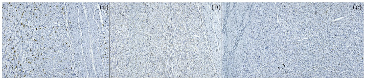 Morphological and Ancillary Features of Uterine Leiomyosarcoma: Case Report.