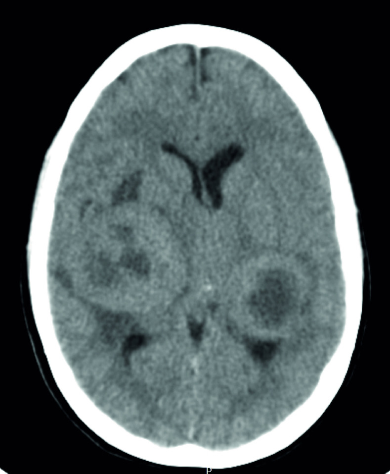 Large mirror brain metastases from primary undifferentiated sarcoma of the breast: case report and review of the literature.