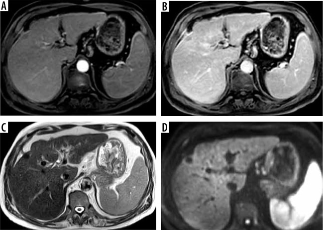 Interrater reliability and agreement of the liver imaging reporting and data system (LI-RADS) v2018 for the evaluation of hepatic lesions.