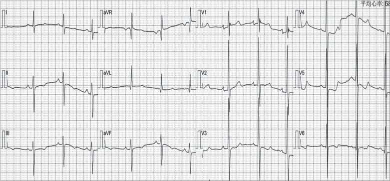 A Novel <i>Loss-of-function</i> Mutation in <i>MYBPC3</i> Causes Familial Hypertrophic Cardiomyopathy with Extreme Intrafamilial Phenotypic Heterogeneity.