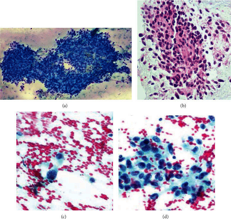 A Rare Case of Metastatic Glioblastoma Diagnosed by Endobronchial Ultrasound-Transbronchial Needle Aspiration.