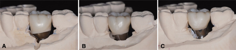 Effect of abutment neck taper and cement types on the amount of remnant cement in cement-retained implant restorations: an <i>in vitro</i> study.