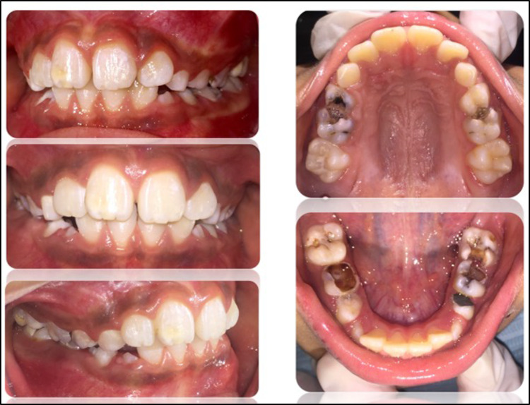 Clinical Management of Molar Incisor Hypomineralization Affected Molars in a Pediatric Patient Including Endodontic Treatment, Case Report and Review of the Literature.